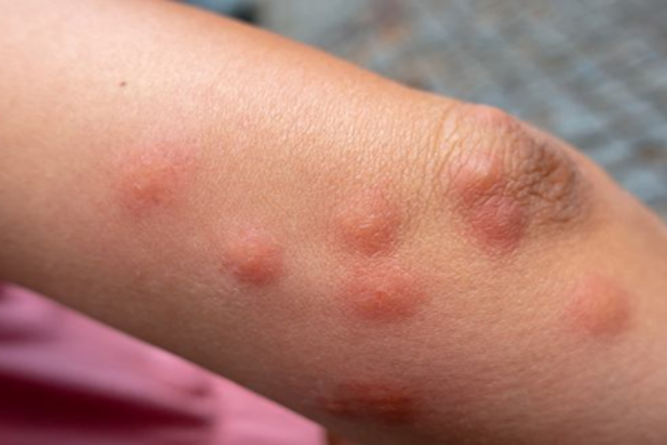 Ugryzienie pluskwy – dezynsekcja